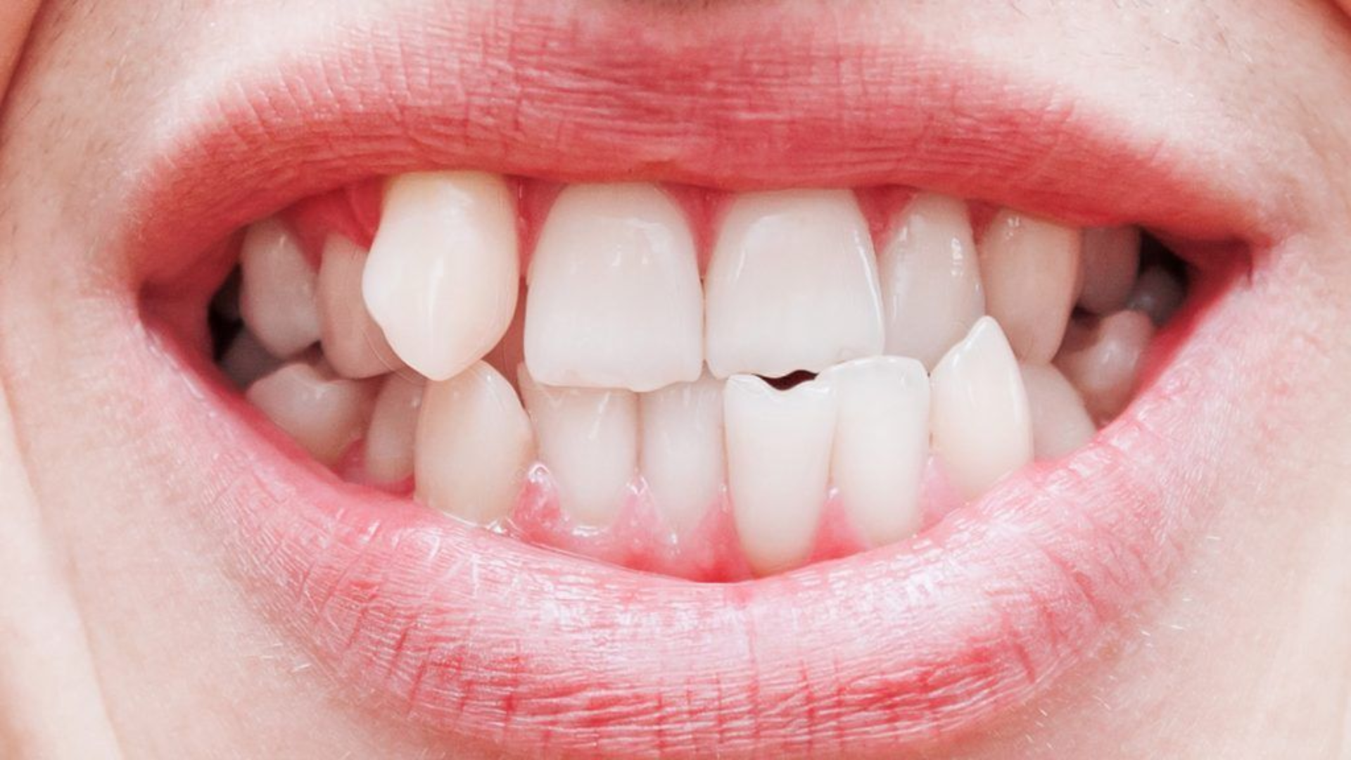 Crooked Teeth Treatment in Lahore