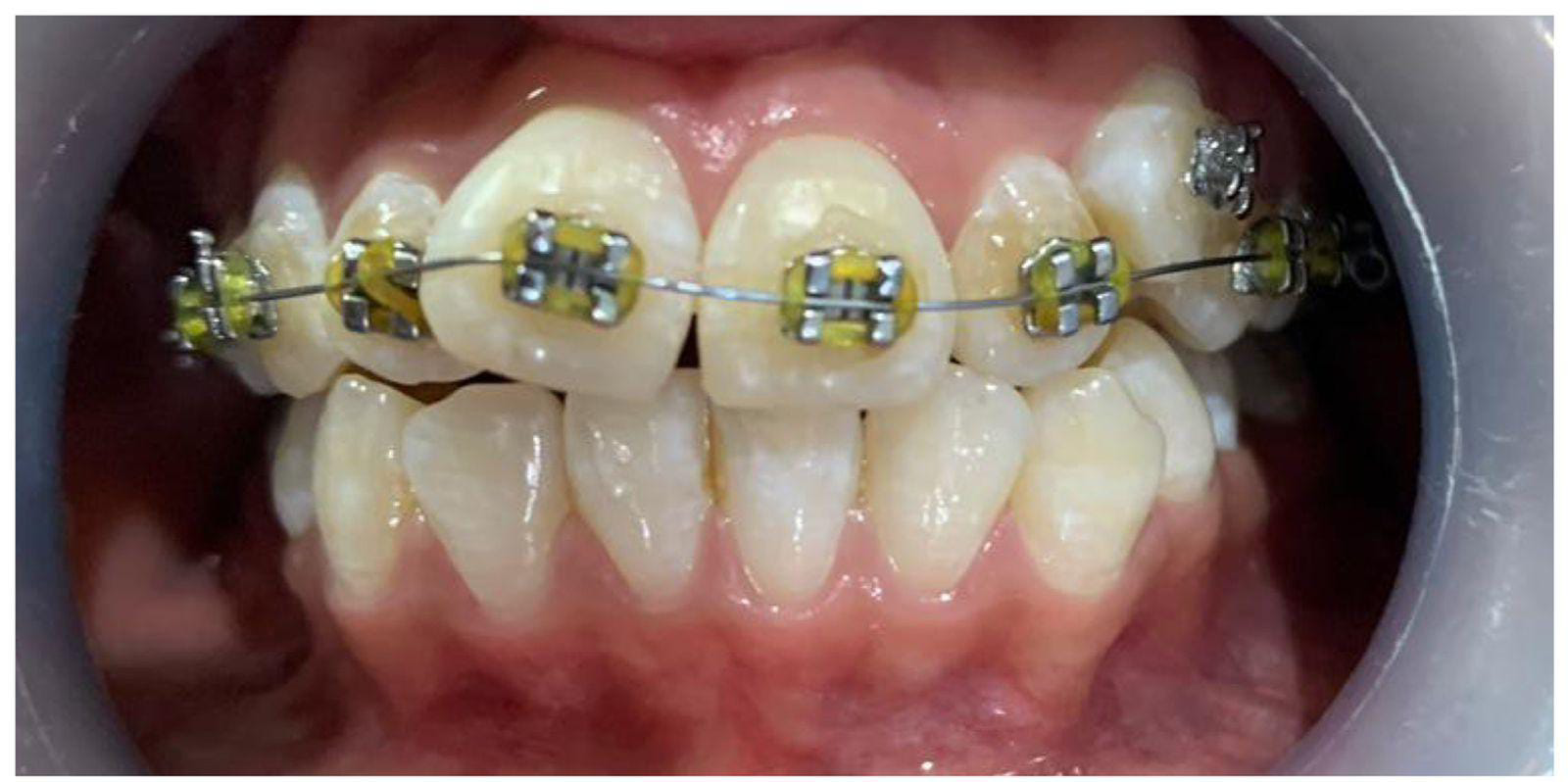 braces price in pakistan lahore