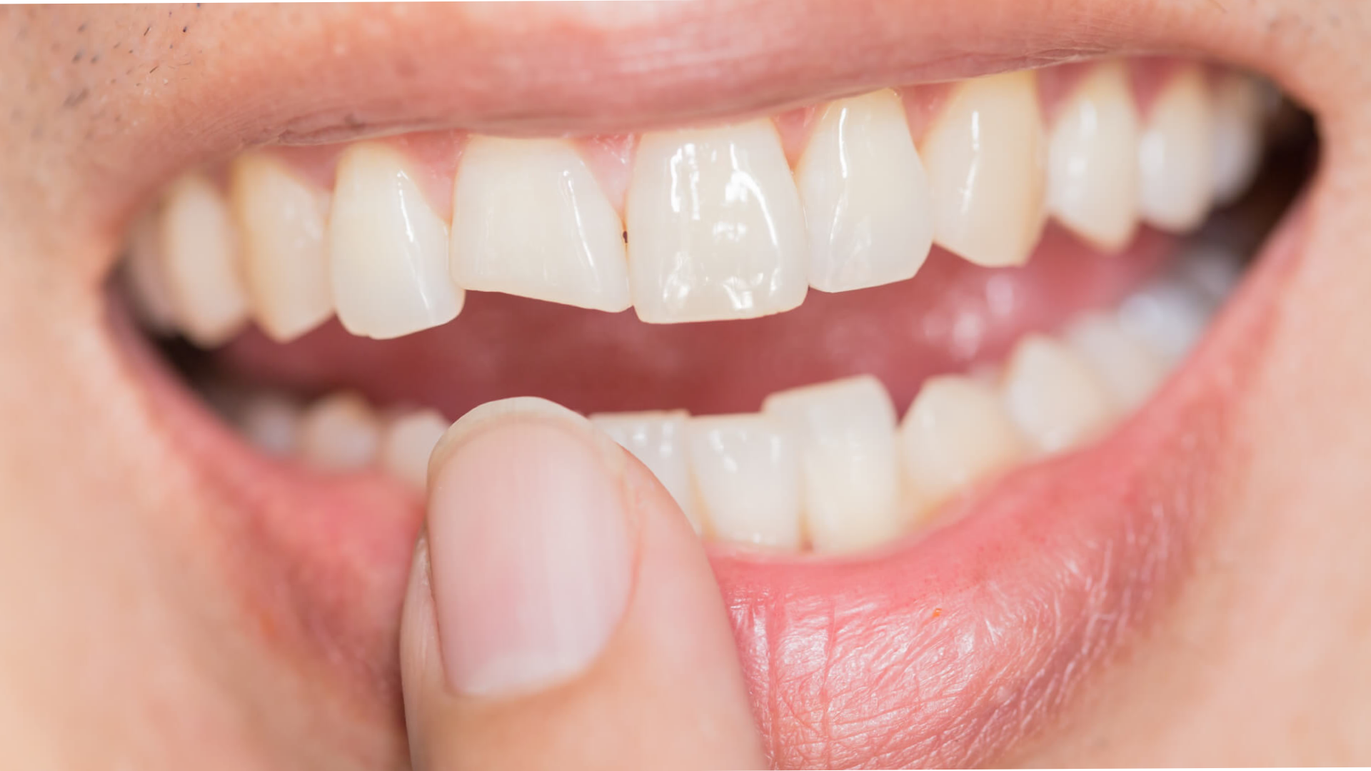 Worn Teeth Treatment in Lahore