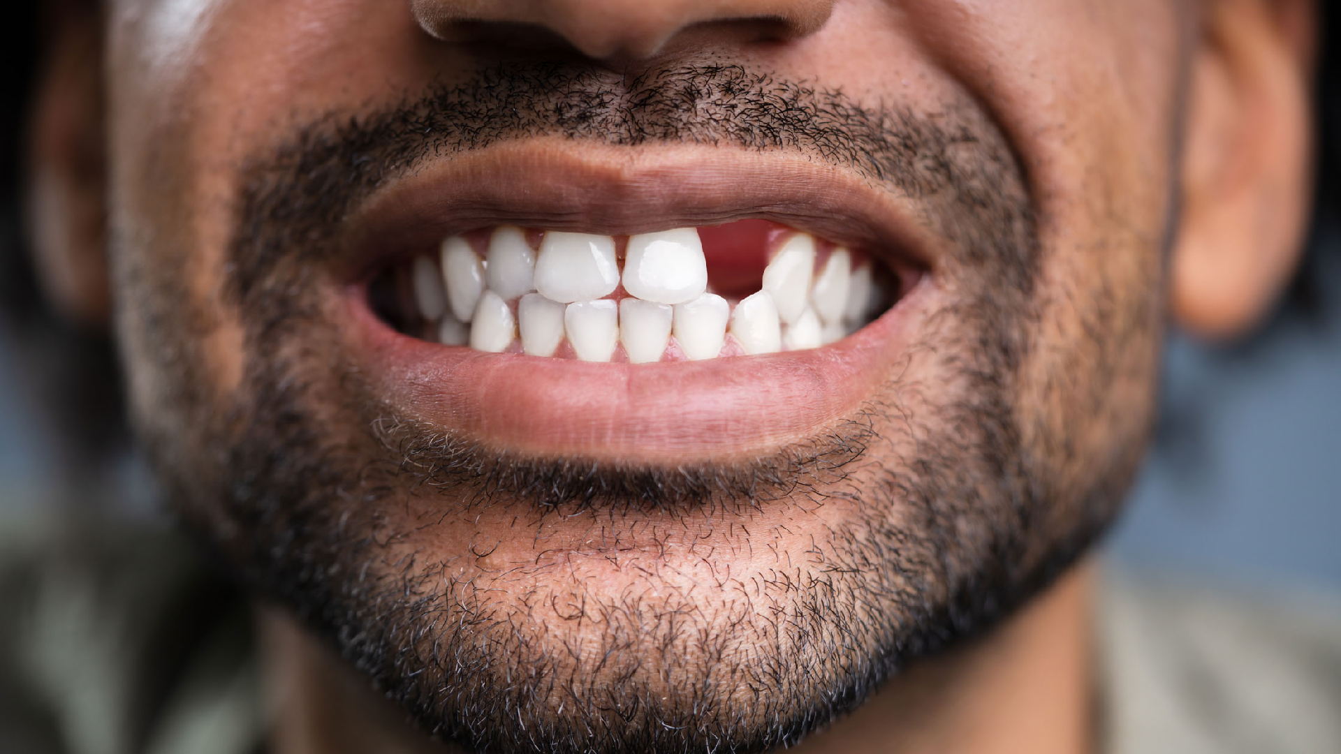 Missing Teeth Treatment