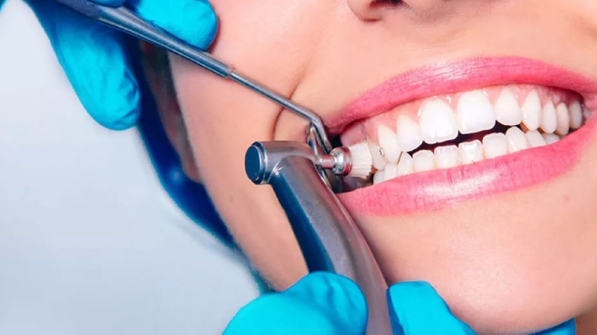 scaling and polishing price in lahore