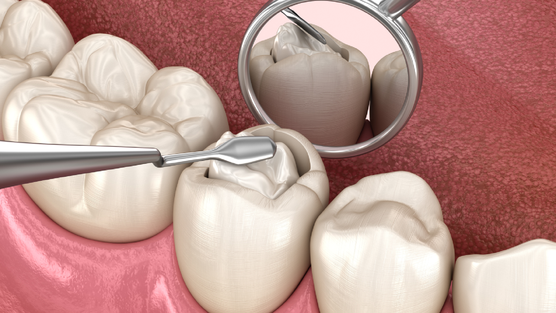 teeth filling price in pakistan