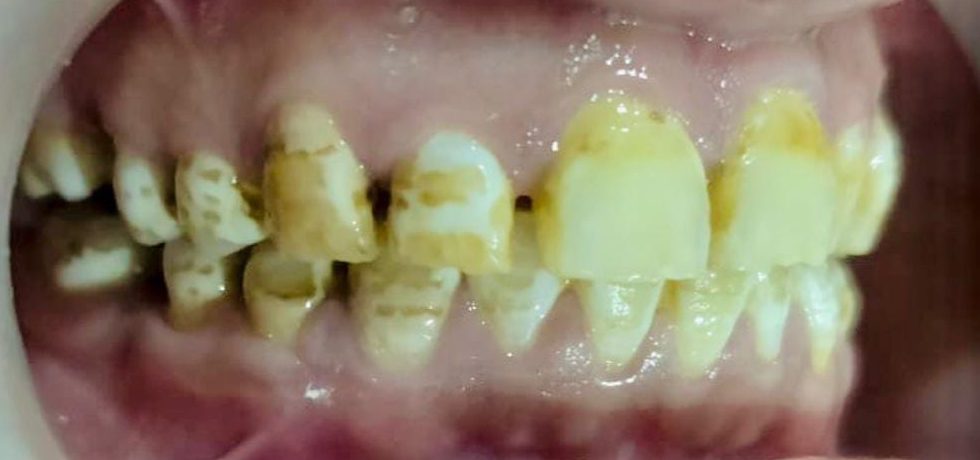 Worn Teeth Treatment in Lahore