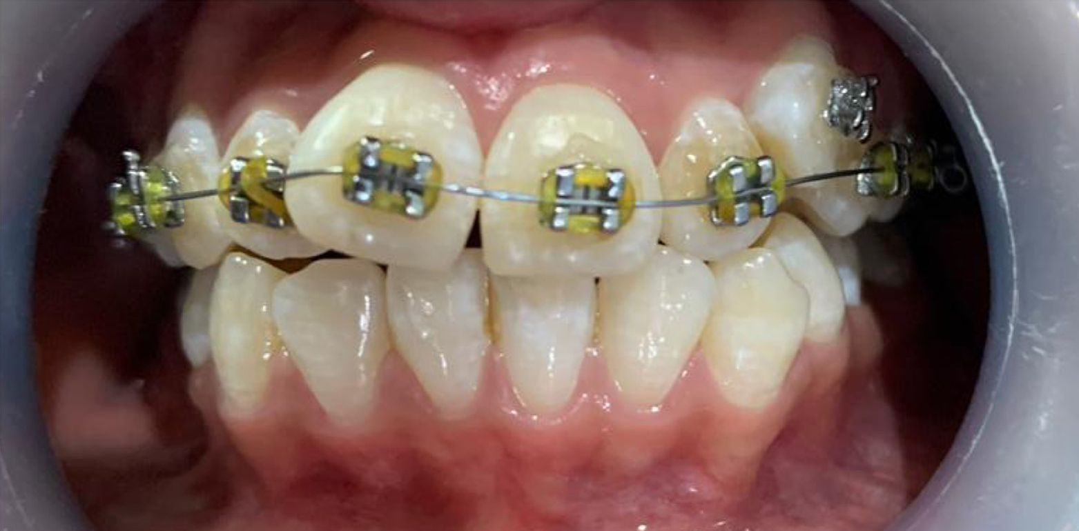 braces price in pakistan lahore