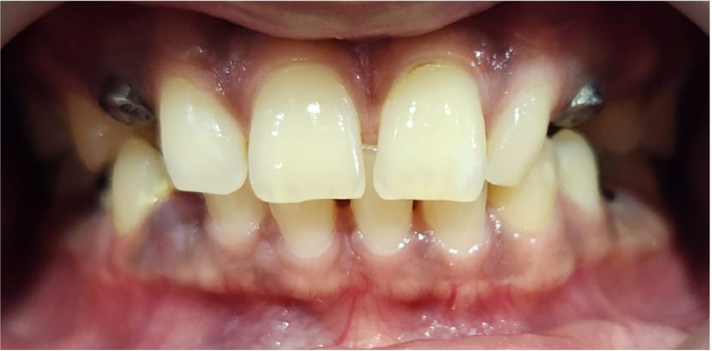 yellow teeth treatment