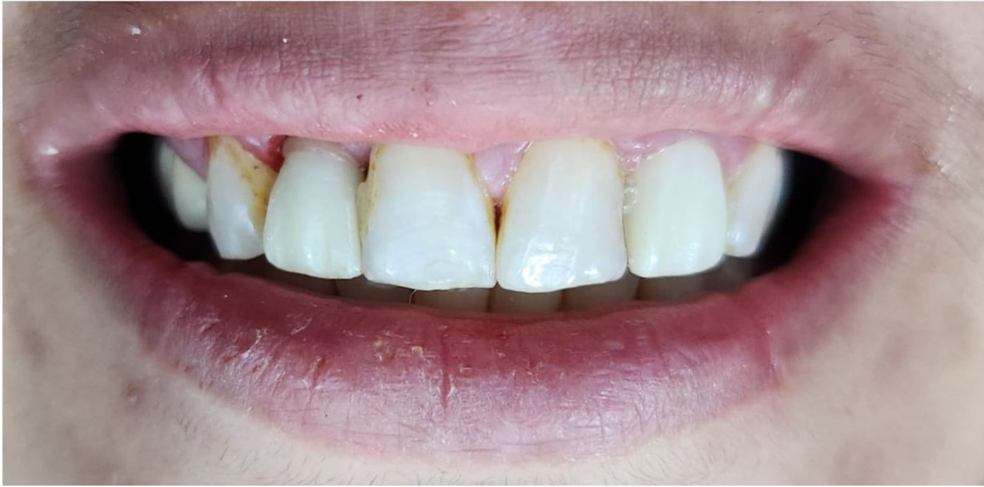 best quality dental implants