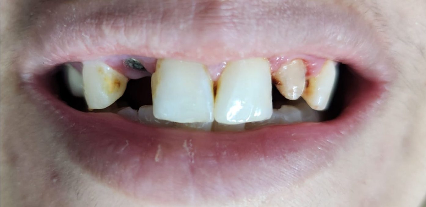 best quality dental implants