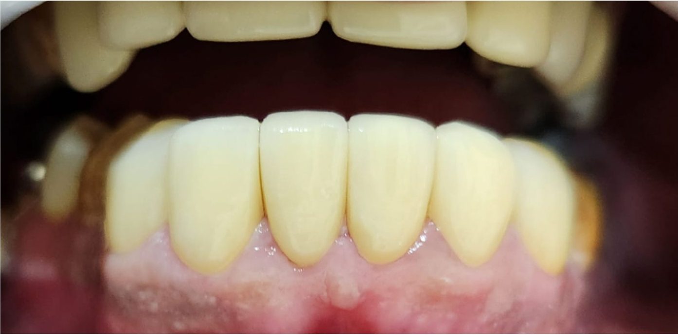 yellow teeth whitening
