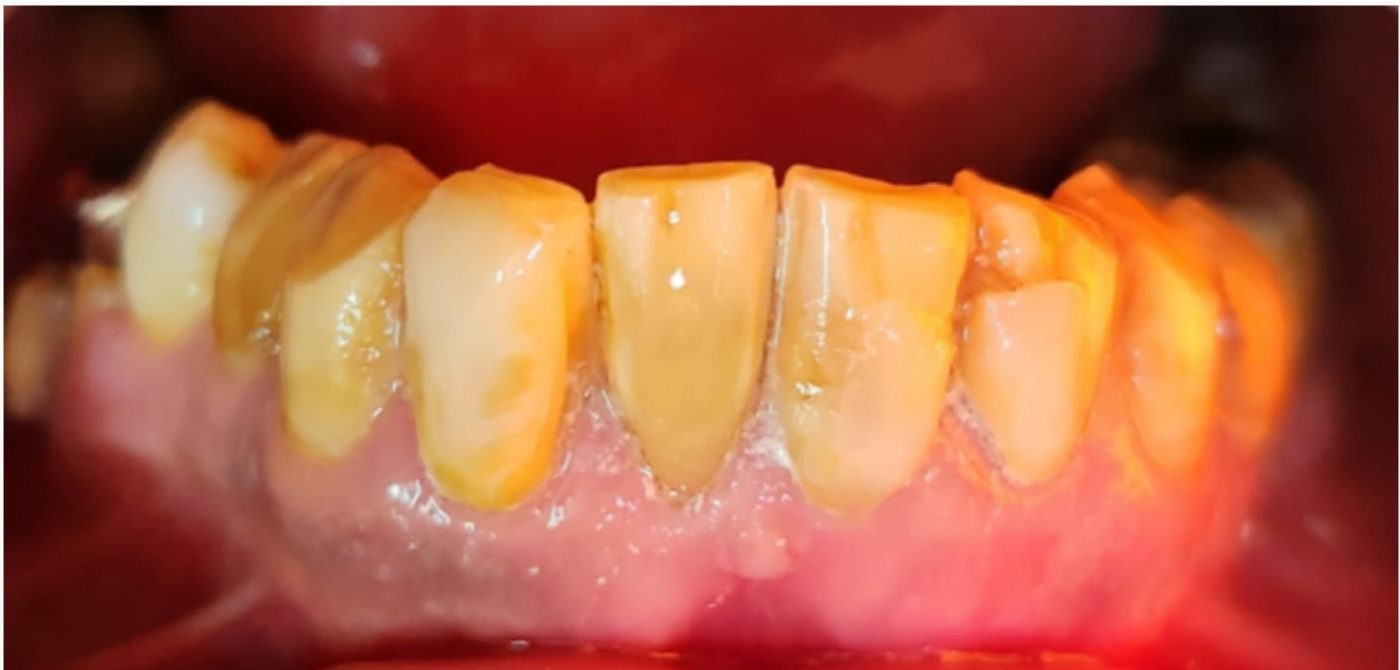 yellow teeth whitening