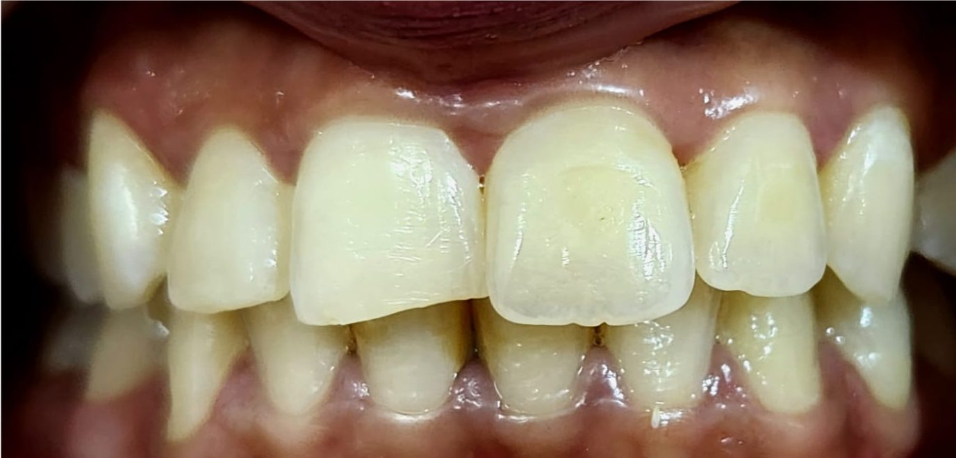 Crooked Teeth Treatment in Lahore