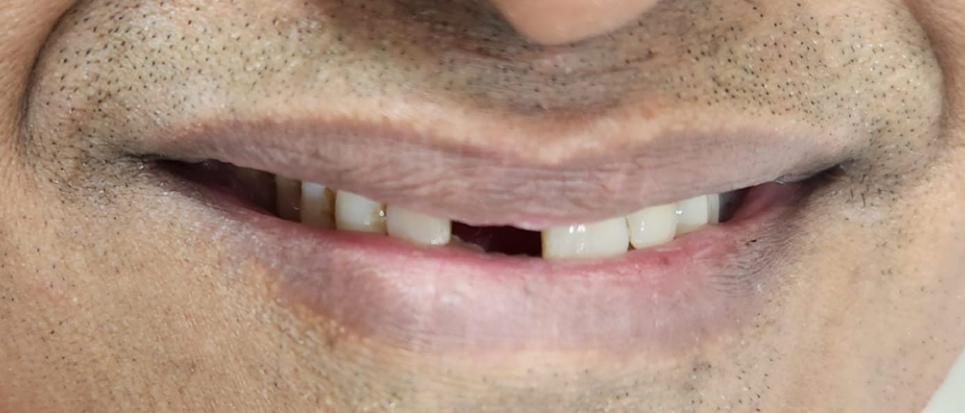 teeth implant price in pakistan
