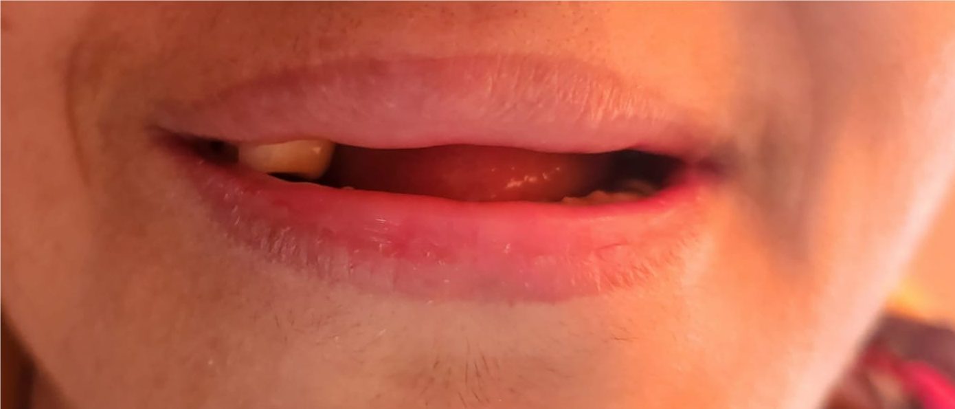 teeth implant price in pakistan