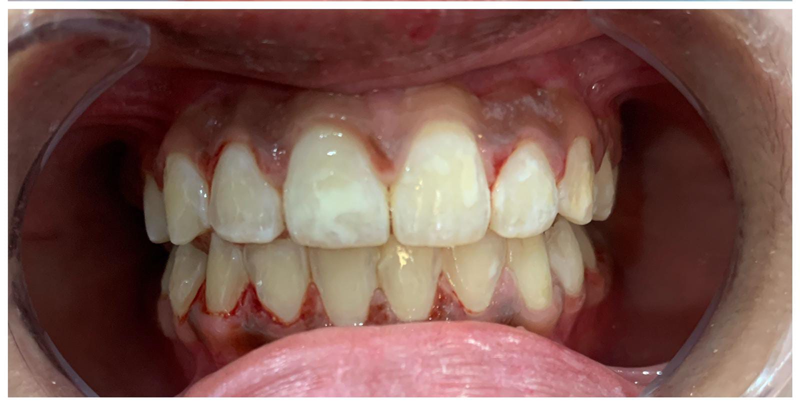 braces price in pakistan lahore