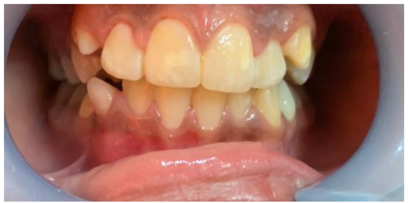 yellow teeth whitening