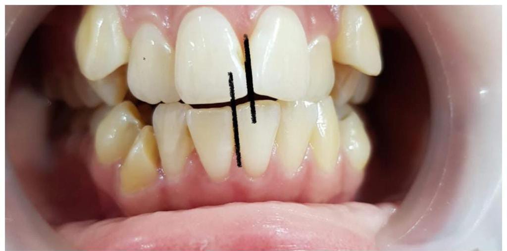 Crooked Teeth Treatment in Lahore