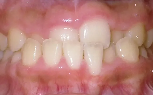 Crooked Teeth Treatment in Lahore