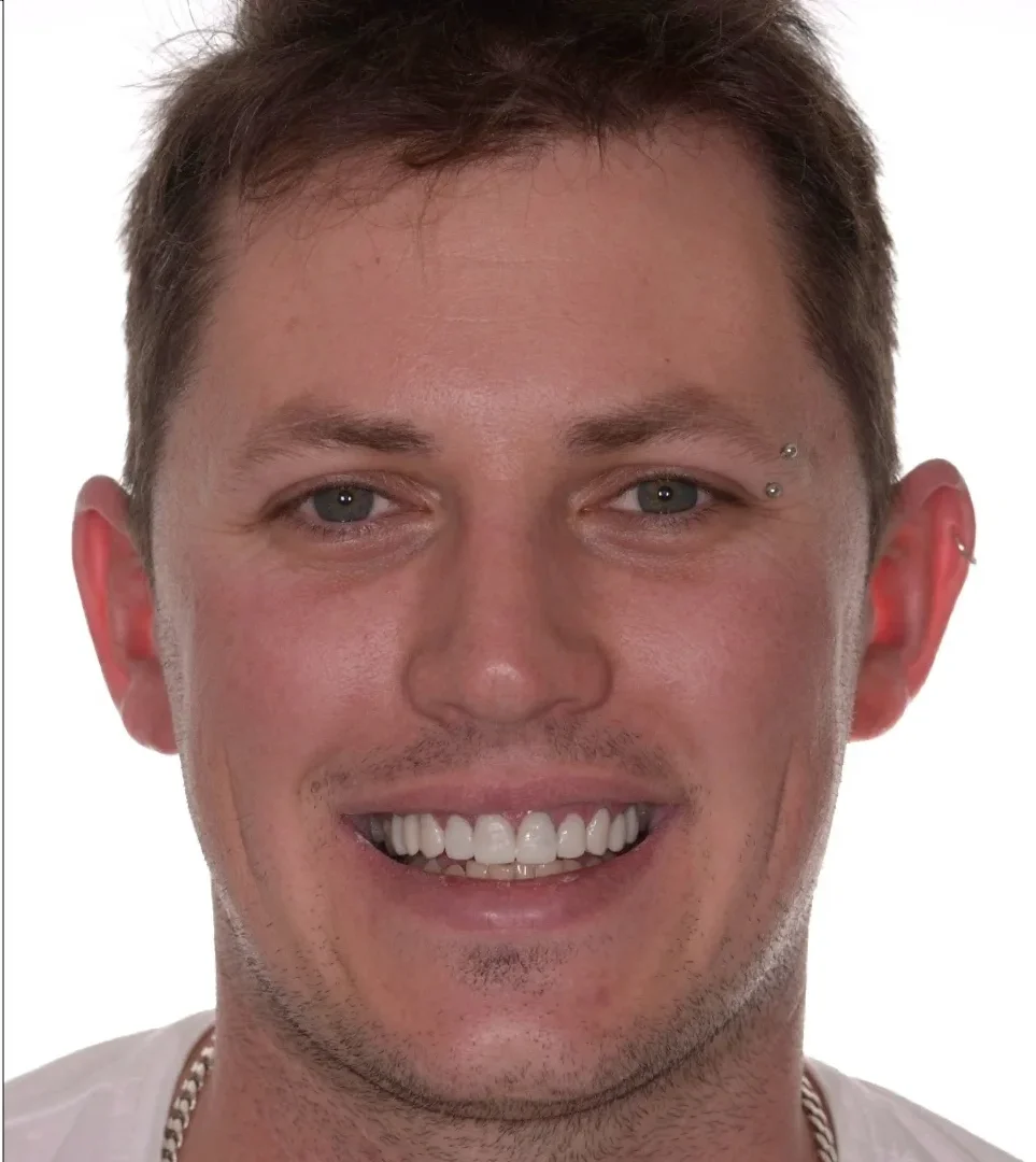 best quality dental implants