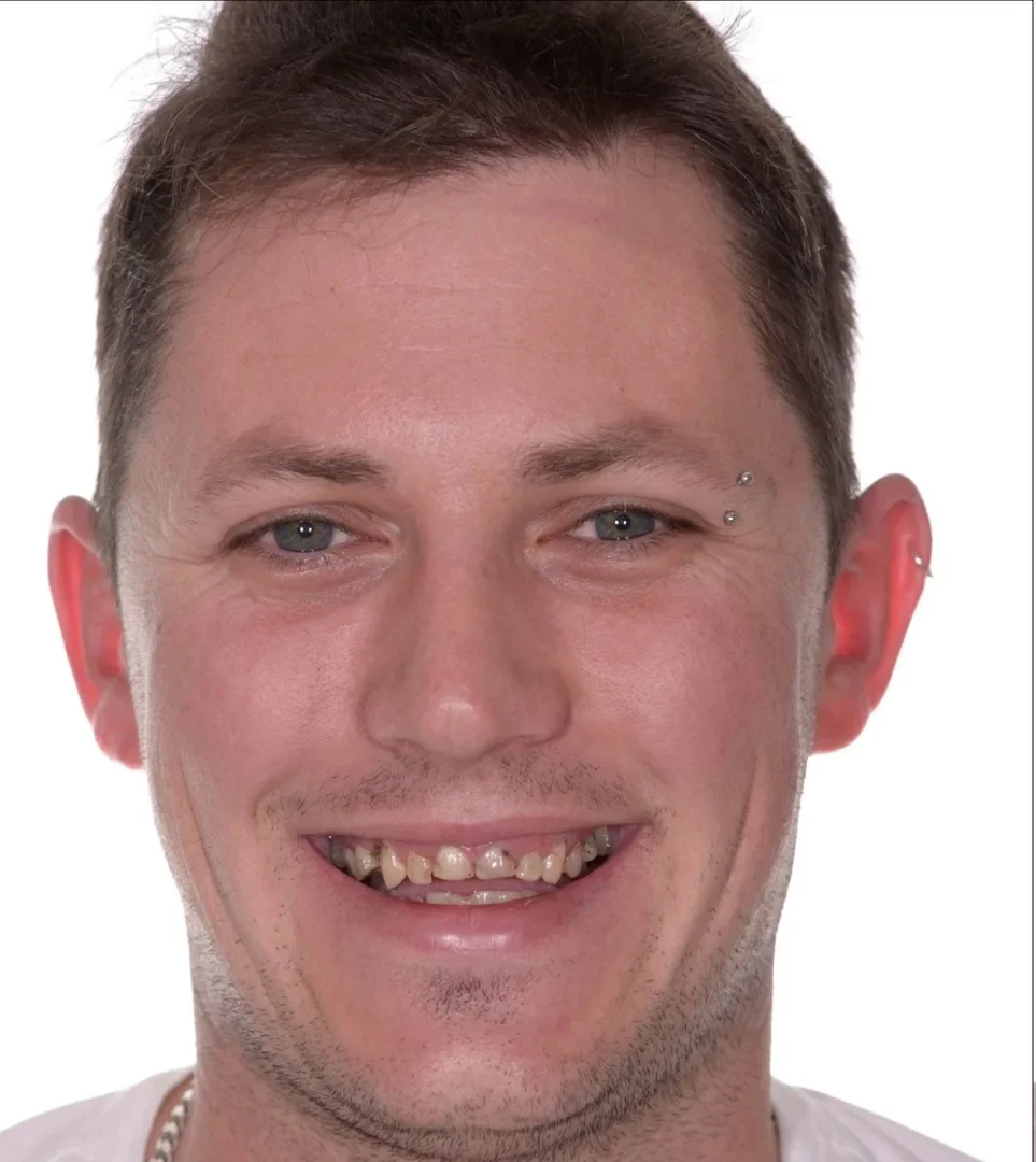best quality dental implants