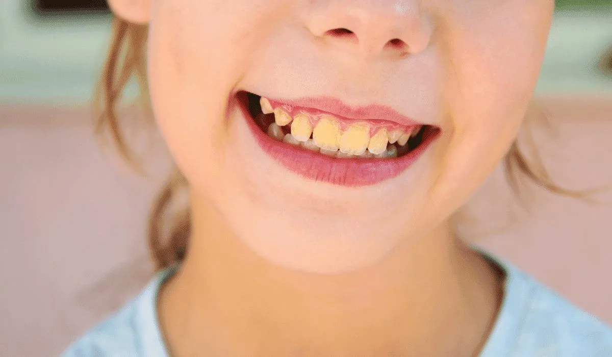 teeth cleaning price in lahore