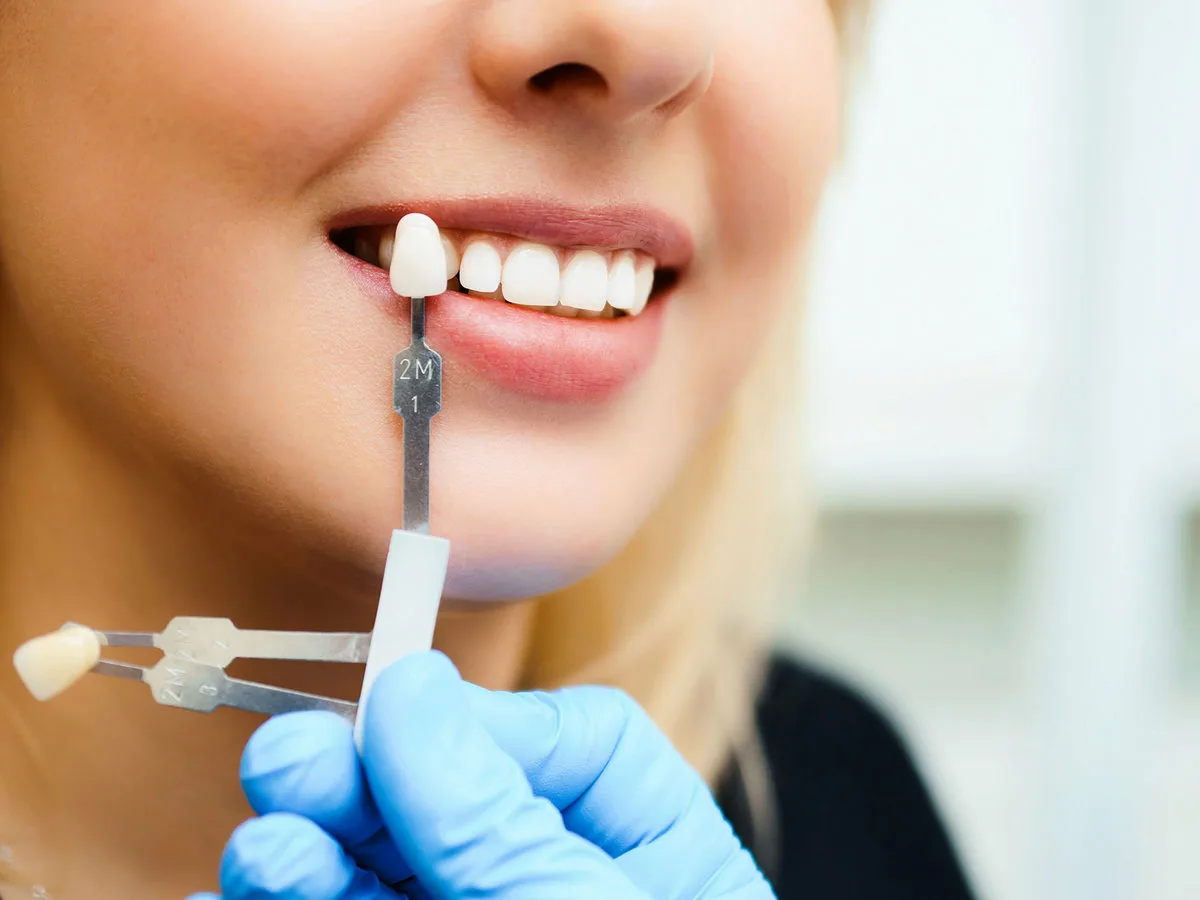 Dental Crowns Treatment in Lahore