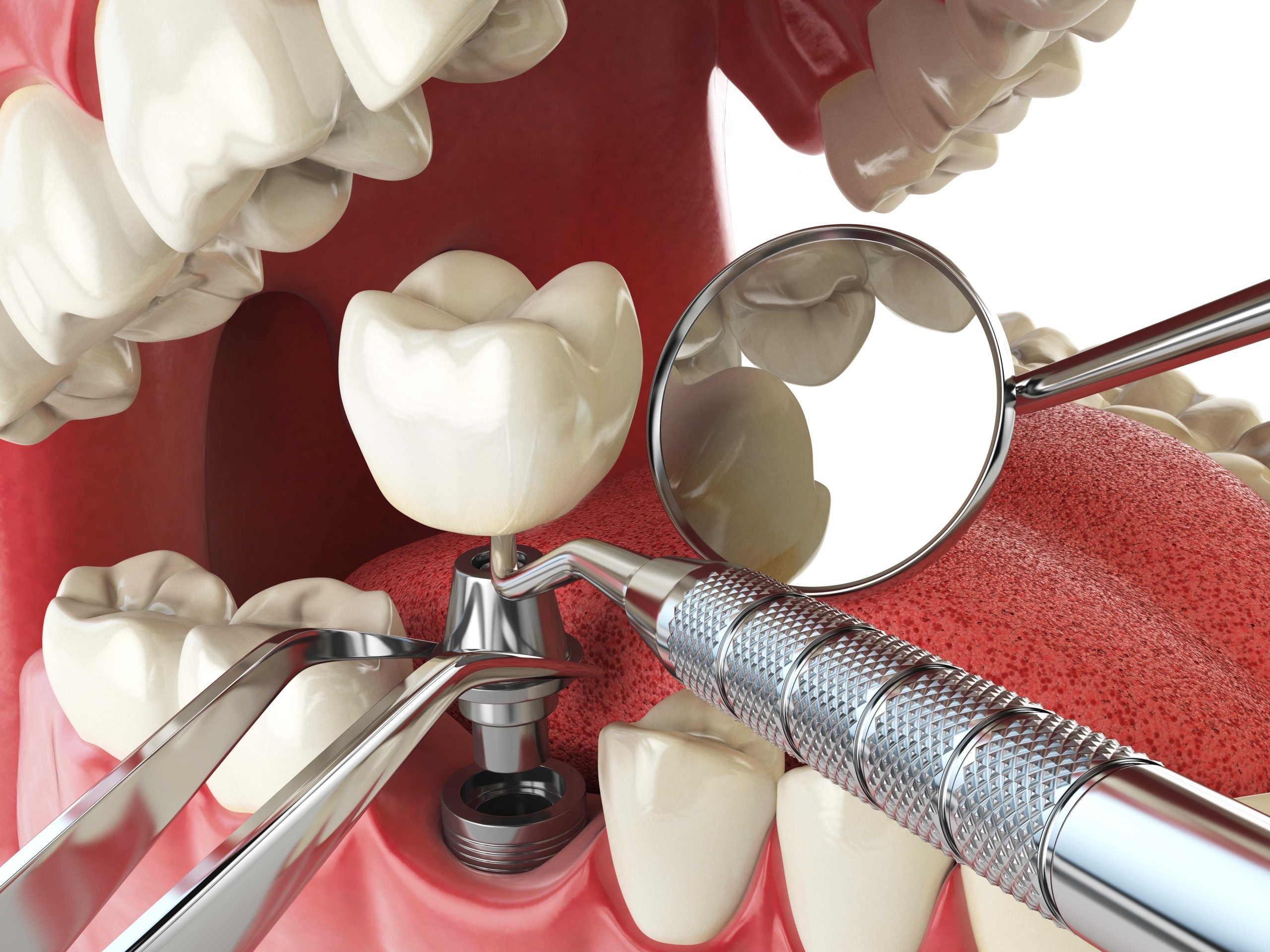 best quality dental implants