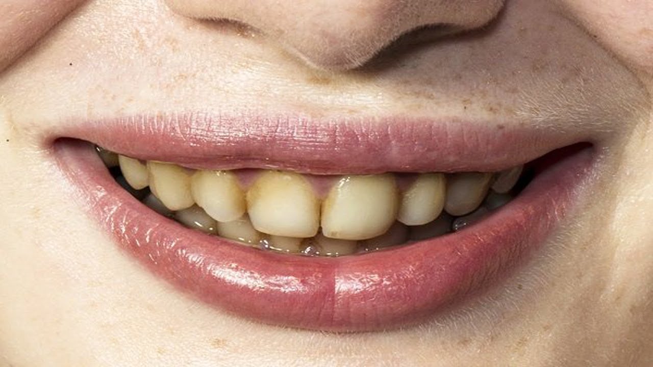 yellow teeth treatment