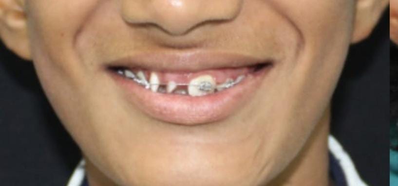 braces price in pakistan lahore