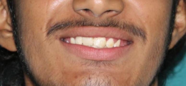 Cosmetic Dental Makeover