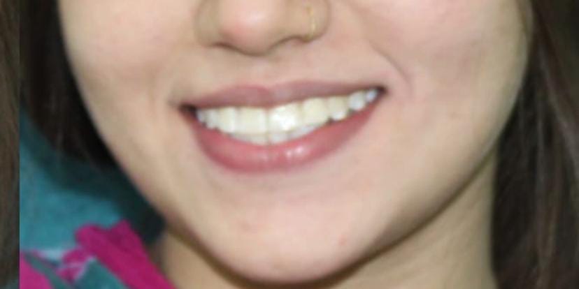 braces price in pakistan lahore