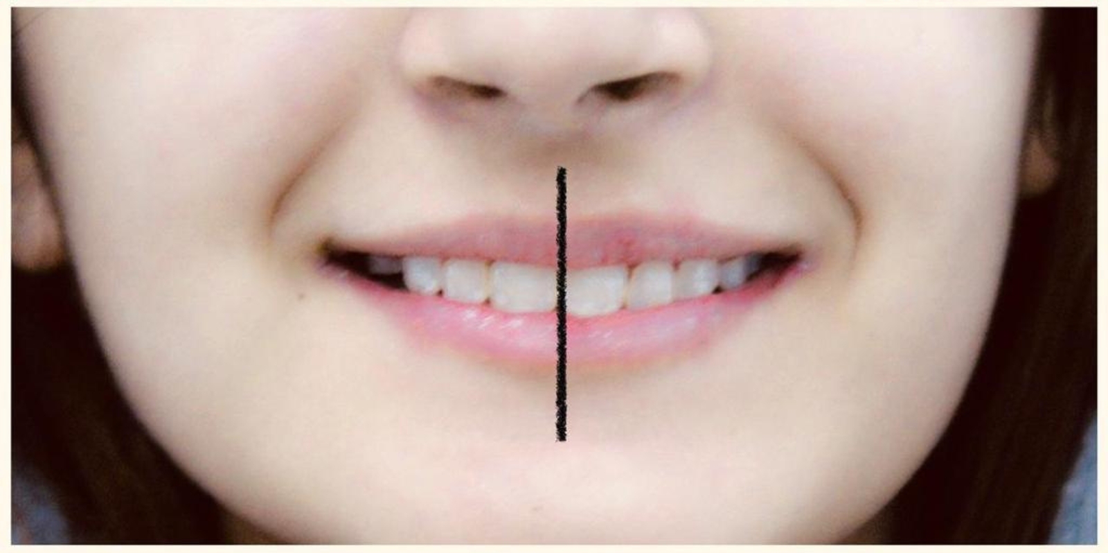 Cosmetic Dental Makeover