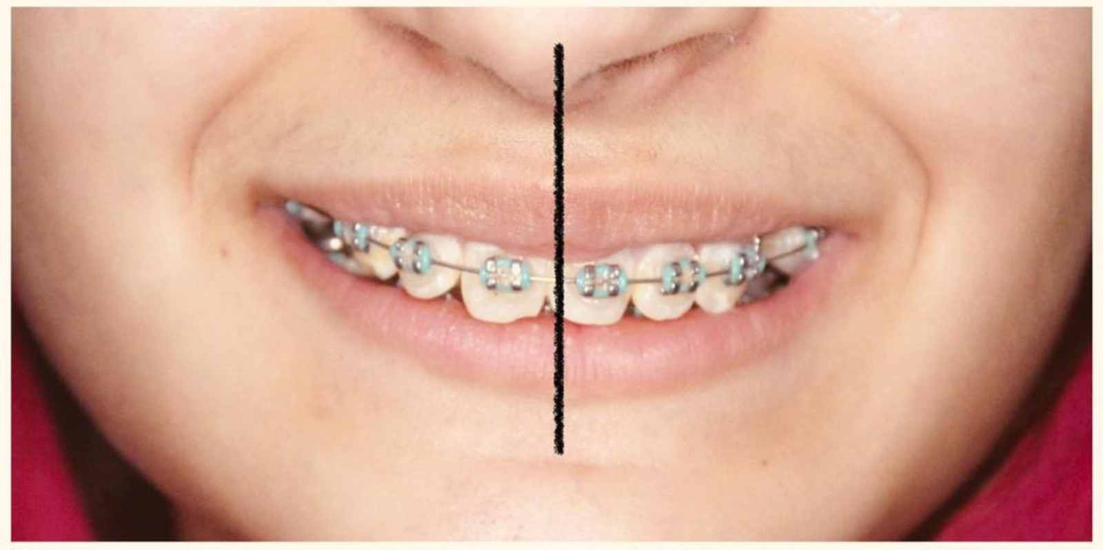 braces price in pakistan lahore